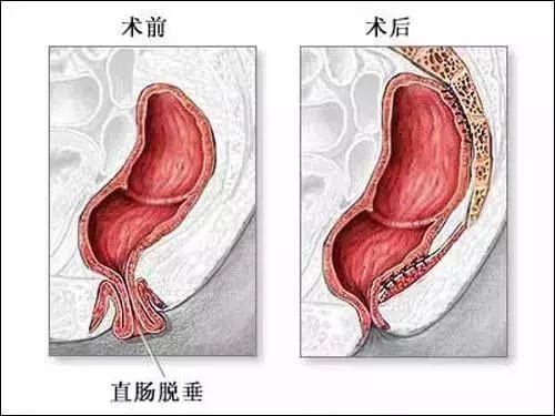 脱肛是什么原因造成的