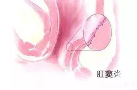 嘉定肛窦炎怎么治疗