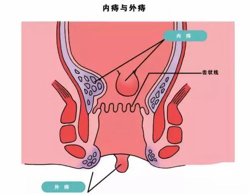 混合痔手术多久能恢复正常