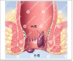 一般内痔疮治疗需要多少钱