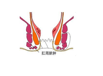 怎么会得肛周脓肿