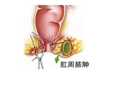 肛周脓肿手术需要多少钱