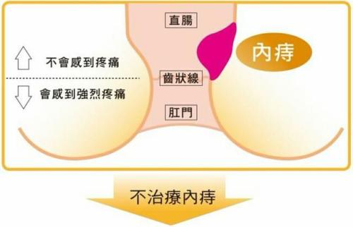 内痔疮的原因有哪些
