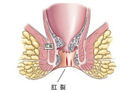 肛裂是怎么引起的