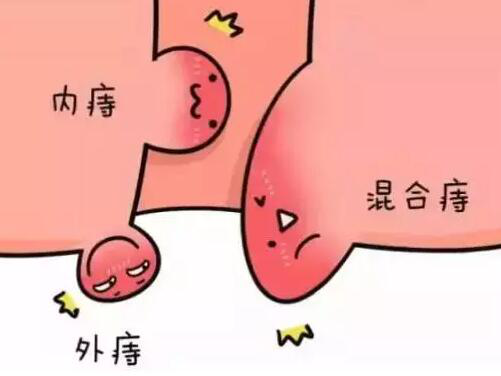  内外混合痔手术多少钱