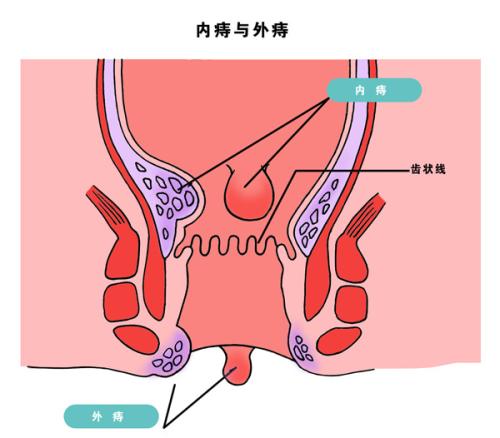 痔疮外痔怎么形成的