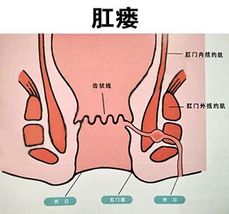 肛瘘混合痔手术多久可以出院？