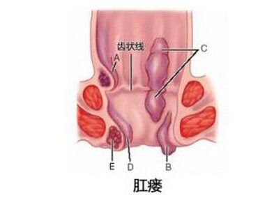 肛瘘不处理有什么后果
