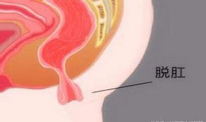 脱肛怎么快速恢复